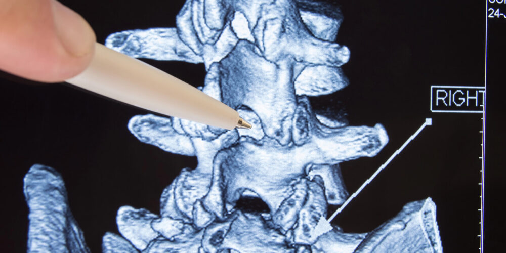 Warsztaty z nakłucia lędźwiowego